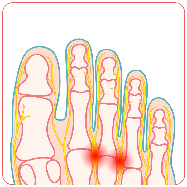 neuroma di morton